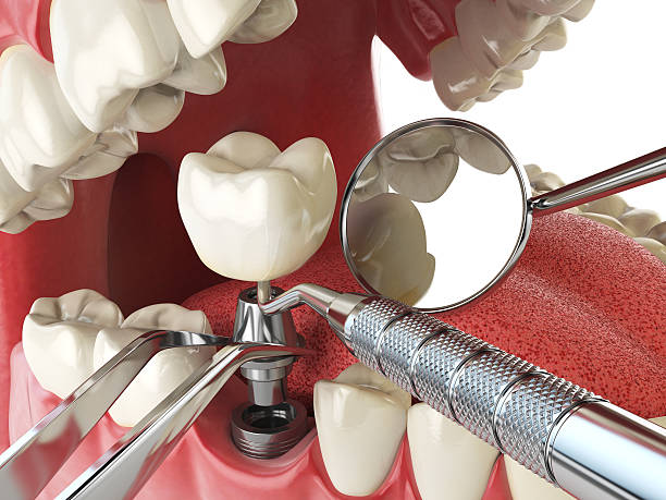 Best Emergency Dental Care for Abscessed Tooth in Georgetown, IL
